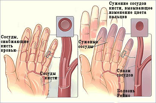  Синдром Рейно характеризуется проблемами с циркуляцией крови во всем организме, но пальцы рук страдают от этого больше всего.